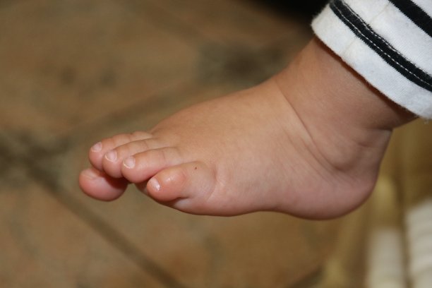 婴儿脚有点弯图片图片
